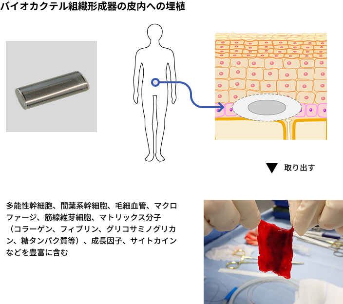 バイオカクテル組織形成器の皮内への埋植