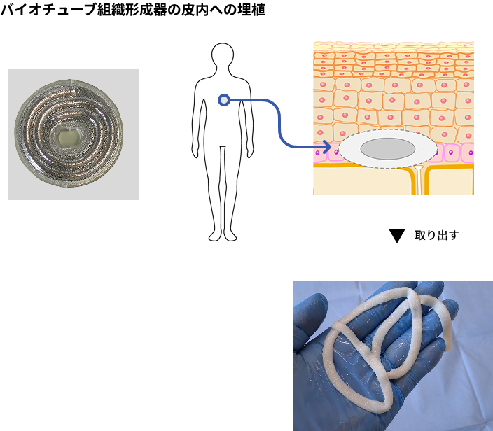 バイオチューブ組織形成器の皮内への埋植